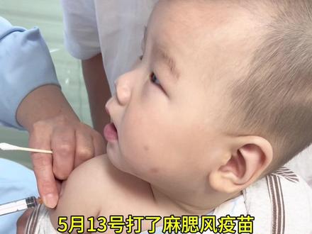 浅谈一下麻腮风疫苗吧,不愧是苗王。我崽是打完之后第八天开始发烧,刚开始发现的时候是他总是哭哭唧唧的,一量体温38.5,然后就给他物理降温,到了晚上体温达到39.5,退烧贴换了又换,用温水擦身子,使劲喂水,难受的他总想睡觉,但是就想在我身上睡,我一晚上不敢睡觉,反反复复的持续了3天,第3天一天没有吃奶,怎么喂都不吃就光想哭光想睡觉,晚上的时候我喂他水,他喝的可多了,平常都不喝,喝完之后上床想喂奶试试,一试就吃了,刚吃两口就吐了,然后就是一点一点的出疹子,之后就是一天比一天多,出疹子之后崽崽更难受了,更粘人,不让哄不让放下的那种,我也很无力,我也想替他难受,很心疼#麻腮风疫苗 #人类幼崽千万别生病😷 #人类幼崽 #宝宝生病快点好起来 #苗王