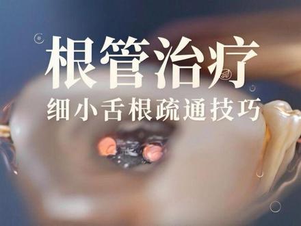 #根管治疗 最近点关注的比较多,手机里有个库存给大家发一个,前磨牙细小近乎看不见的一个舌根的疏通,技巧很多,有什么疑问发出来,有空会回答
