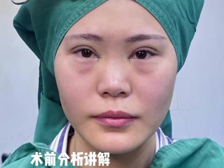 自然偏夸张款扇形双眼皮#扇形双眼皮 #双眼皮手术 #科普知识 #双眼皮修复