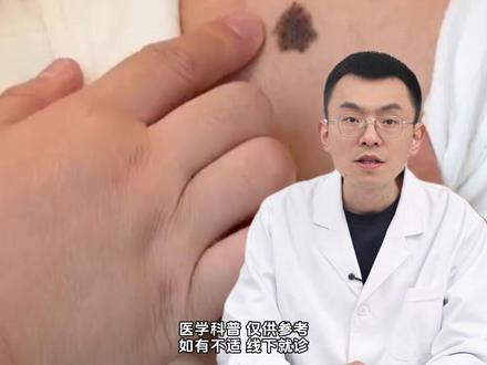 身上这 5 种痣有癌变风险!早发现很重要 #黑痣 #黑色素瘤 #黑痣和黑色素瘤的区别 #抖出健康知识宝藏 #我的年度健康盘点