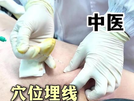 夏天想穿吊带,患者:背部多扎点 #穴位埋线 #郭广宇预约 #瘦背 #瘦腿 #埋线减肥