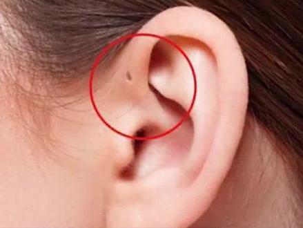 你的耳朵上有这种小洞吗?#健康 #医学科普 @抖音小助手