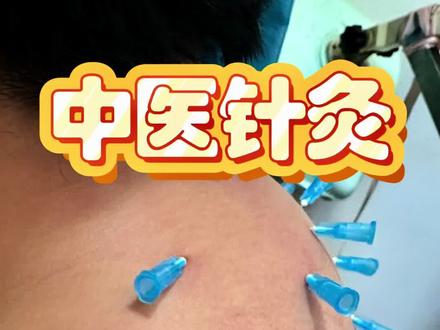后背埋根“能量线”,经络通了,背薄了,人也挺拔了
#埋线 #富贵包 #中医针灸 #鞍山小倪 #鞍山市中医院