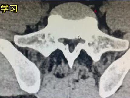 什么是侧隐窝狭窄? #腰椎管狭窄 #腰椎间盘突出#医学科普