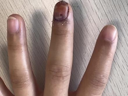 #血管球瘤 #甲床
甲床损伤修复后,或者甲床病灶切除术后,应当用原甲板或者人造甲板(输液器的小壶制作)覆盖在甲床上,可以将甲根皱襞和甲基质隔开以免影响指甲生长,减轻甲床面的肉芽生长,也可不让甲床与敷料粘连,减轻换药时的痛苦。
微创不仅仅只切口小,而是一种原则,应当贯穿于整个手术过程中!