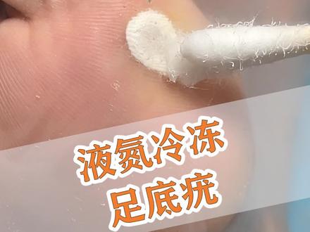 每周疣一冷冻又来了,其实如果起水泡没破溃可以少量接触水!#樊哥撩皮肤 #疣 #冷冻 #液氮冷冻 #知识创作人