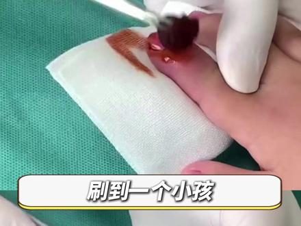 孩子手上扎了刺,怎么都挤不出东西来,这可能是 #玻璃纤维 !教你4招正确处理#生活小妙招 #涨知识 #儿童健康 #抖出健康知识宝藏