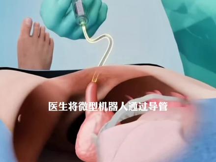 #科普 #涨知识 #每天学习一点点 #每天跟我涨知识 #创作人计划 医生将微型机器人通过导管滑入你的膀胱