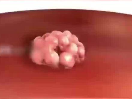 99%的尖锐湿疣患者看完这条就够了 #尖锐湿you #HPV#hpv感染#扁平疣#尖锐湿尤