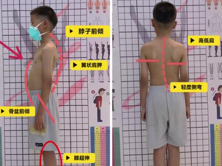 小朋友全身体态问题比较多时,就这么练!今天给大家讲透逻辑#青少儿体态 #居家锻炼 #体态纠正 #孩子体态问题的解决方法 #关爱孩子生长发育