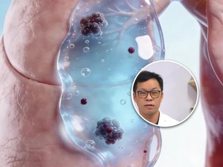 粘液性腺癌治疗思路和普通肺腺癌不一样 #抖出健康知识宝藏 #肺腺癌 #粘液性腺癌 #新年囤点专业货 #春节世界观察