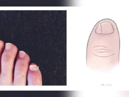 #小脚趾指甲分两瓣是什么说法 有说指甲分瓣表示是山西的,客家的,满族的,中原的……赶快看看你的小脚趾指甲有没有分瓣!