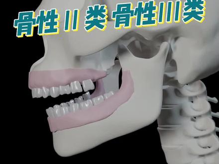 什么是骨性二类 骨性三类#正颌 #口腔科普 #牙齿
