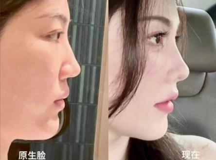 全网最全鼻基底功课#变美 #鼻子