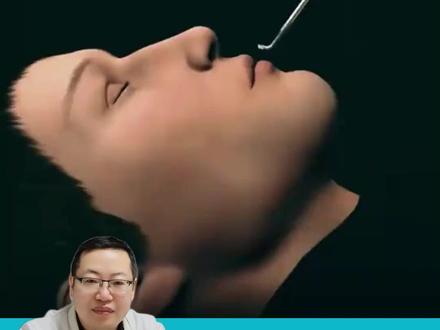 鼻窦手术全过程,动画讲解 #鼻窦手术 #动画演示 #手术过程