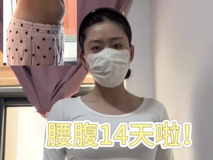 腰腹环吸有色素 棉布终于可以取下来了,天天包着棉布难受死了,效果目前看很满意,有些色素沉着,一点不要挠 ,虽然很痒吧,可以吃抗过敏药缓解一下#腰腹环吸 #恢复 #色素沉着