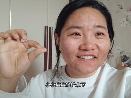 战痘快一年了,时好时坏,什么时候才可以好 #痘印 #抗痘 #痘痘肌