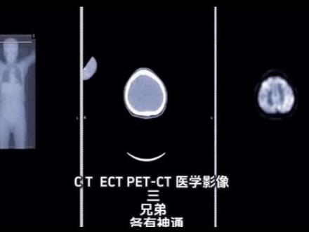 CT.ECT.PET-CT三兄弟的区别