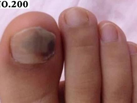 指甲突然变黑,别急可能是这个原因#医学科普 #指甲