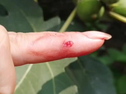 用无花果汁去刺瘊子,可以看看