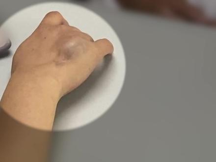 手背腺泡状横纹肌肉瘤,复发+转移,尽力把食指保住吧!#医学科普 #肿瘤 #骨肉瘤 #截肢 #沈靖南