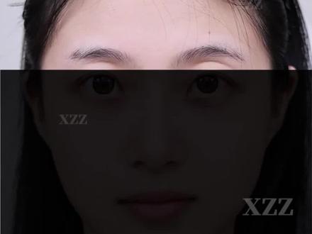 2个点位,提高面部折叠度,实现大脸变小 #大脸变小 #面部立体度 #额结节 #面部折叠度 #上海注射医生
