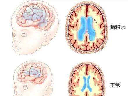 这种脑积水大部分自己会好,不用特别治疗,家长不用过度焦虑。#宝宝脑积水 #外部性脑积水 #健康科普