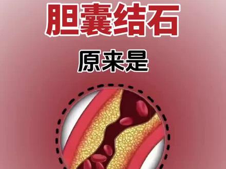 #胆结石#结石#健康科普#FreeHalo石通胶囊
