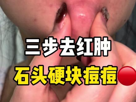 三步去红肿痘~#原相机 #痘痘肌 #红肿痘