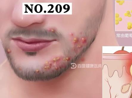 男性下巴上长痘痘,是最难受的,轻轻碰一下都很痛,也不能刮胡子。#皮肤 #科普