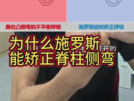 脊柱侧弯训练日常案例,为什么施罗斯能矫正脊柱侧弯#脊柱侧弯 #体态纠正 #施罗斯矫形体操 #运动康复
