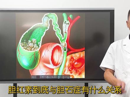 胆红素偏高就意味着有胆结石吗?聊聊胆色素结石的形成条件 #医学科普 #抖医医生 #医学常识 #胆结石 #中药