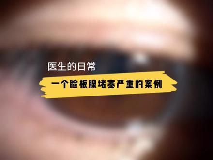 睑板腺堵塞严重,能到什么程度?为什么会这么严重呢?#睑板腺按摩
