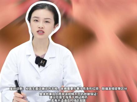 冬天长冻疮又疼又痒,医生手把手教你处理,少受罪!#冻疮 #冬天 #医学科普 #抖出健康知识宝藏 #医疗健康创作训练营
