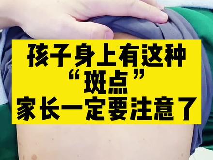 孩子身上有这种斑点,家长一定要重视了#脊柱侧弯 #牛奶咖啡斑 #神经纤维瘤 #儿童脊柱侧弯 #医学科普 #骨科 #斑点 #脊柱侧弯科普