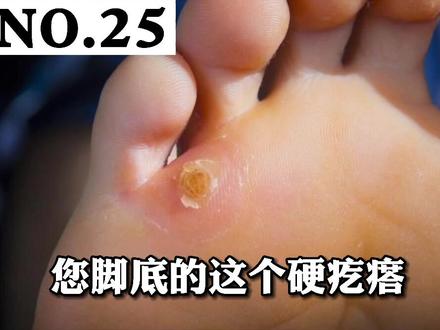 痛痛痛!长了鸡眼怎么办?#鸡眼 #皮肤 #科普