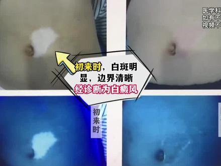 白斑和白癜风的区别是什么,白癜风在伍德灯下是什么样的,一条视频带你了解。#白斑和白癜风的区别 #白癜风在伍德灯下是什么样的 #成都