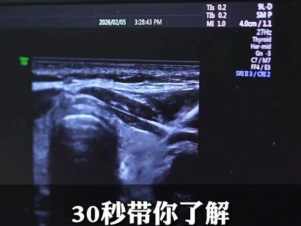 甲状腺结节细针穿刺过程#甲状腺穿刺 #甲状腺结节 #医学科普仅供参考如有不适请线下就医