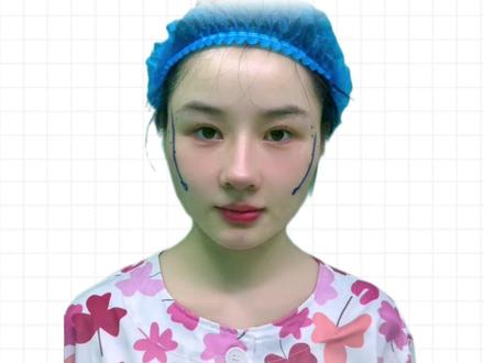 21岁湖南女孩 硬核改脸记 #磨骨改脸型 #磨骨 #磨骨三件套