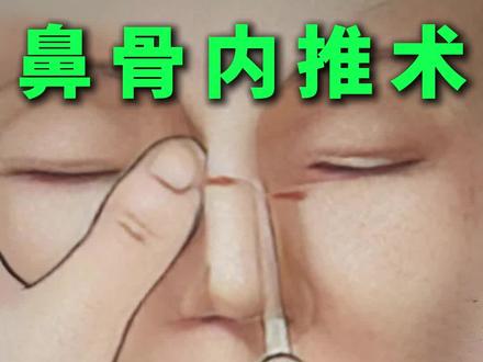 什么是鼻骨内推术 #隆鼻