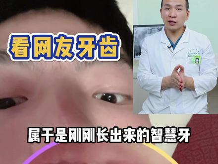今天来看那这位网友智齿,刚刚长出来,合拍来源:@东东睡不醒 #焦九阳医生来看牙 #智齿