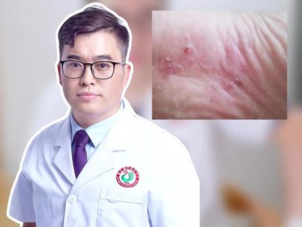 一个视频教你解决三种脚气。#足癣 #脚气 #医学健康知识
