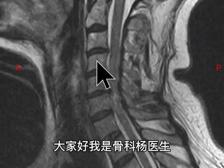 颈椎轻微损伤出现高位截瘫,有这种颈椎病的人要警惕 #脊髓型颈椎病 #颈椎管狭窄 #截瘫 #健康科普