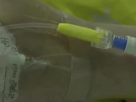 6岁女童空腹吃十几颗荔枝,出现嗜睡,患上“荔枝病”。医生:此病严重时可致休克,正常成年人一次最多吃10到15颗。