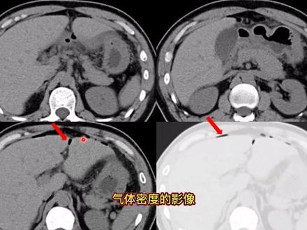 36岁男性,剧烈腹痛,X光片未见明显异常,CT发现了什么?