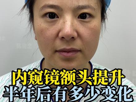 额头提升半年后 #额头提升 #内窥镜额头提升 #额头提升陈建忠 #眉压眼 #眉眼间距窄