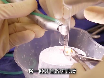 将一颗牙齿放进眼睛!失明几十年也能重见光明?#涨知识 #科普