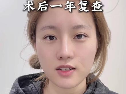 微起伏妈生鼻术后一年复查 #隆鼻 #鼻综合 #妈生鼻 #鼻整形