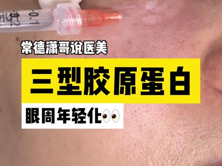 三型胶原蛋白是直接注射作用于真皮层,补充皮肤流失的胶原支架,从深层滋养、撑起细纹,让眼周皮肤重新饱满细腻,而不是只停留在表皮。#眼周细纹 #眼周年轻化 #眼周抗衰 #三型胶原蛋白 #皮肤美容科陈潇