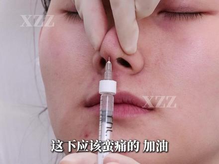 拉出面中,鼻翼内收,侧颜立体精致 #鼻翼缩小 #塌鼻子 #面中凹陷 #微调 #注射隆鼻